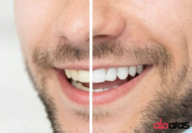 روش سفید شدن دندان