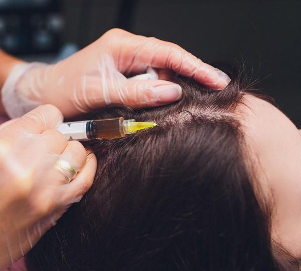 مزوتراپی مو چیست و تاثیر مزوتراپی بعد از کاشت مو